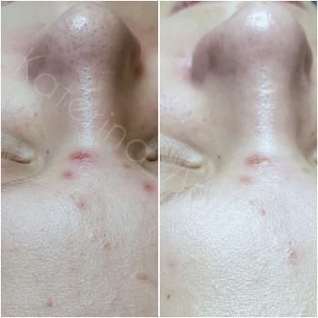 Чистка лица