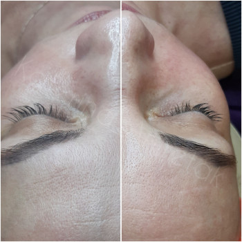 Рф лифтинг + электропорация