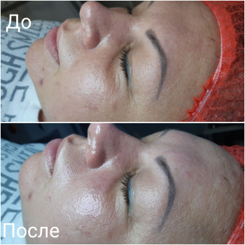 Чистка лица