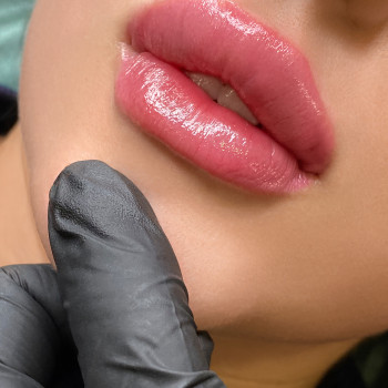 Увеличение губ
                    Косметолог Мирослава Харків