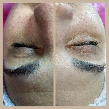 Пилинг лица до и после первой процедуры, пилинг легкий без ш