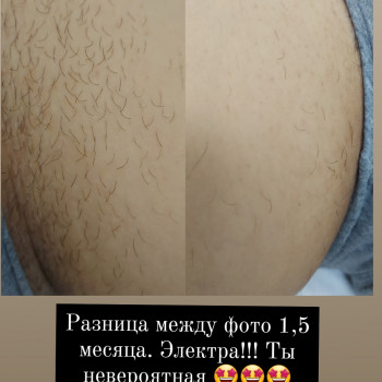 Електроепіляція зони бікіні