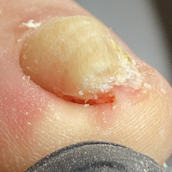 Фото из портфолио специалиста Євгенія Обух (подолог, Ивано-Франковск)