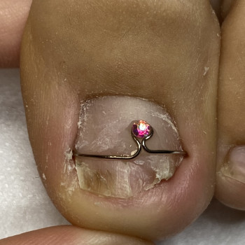 Фото из портфолио специалиста Євгенія Обух (подолог, Ивано-Франковск)