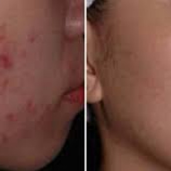 Фото з портфоліо салону Empyreal Бюти Центр (косметологічний центр, Львів)