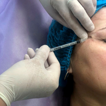 Ботулинотерапия (уколы ботокса)