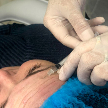 Ботулинотерапия (уколы ботокса)