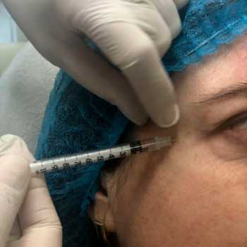 Ботулинотерапия (уколы ботокса)