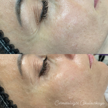 Чистка лица
                    Врач-косметолог Наталья Киев