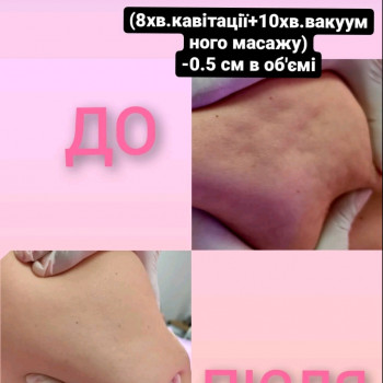 Вакуумно-импульсный термомассаж
                    Массажист Татьяна Киев