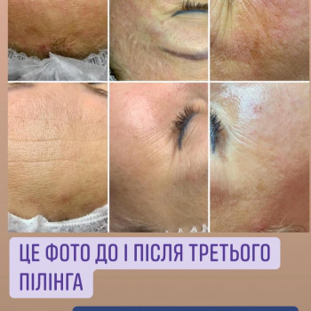 Омолоджуючи та освітлюючі пілінги
Домашній догляд