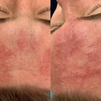 Ботулопептид