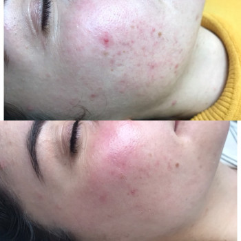 Мікродермобразія