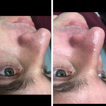 Чоловіча чистка