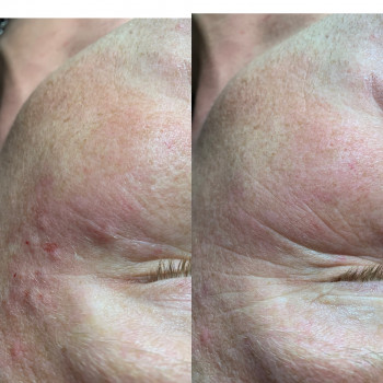 Ботулопептид