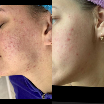 Чистка обличчя
                    Лікар-косметолог Христина Тернопіль