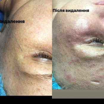 Чистка обличчя
                    Лікар-косметолог Христина Тернопіль