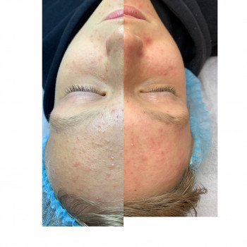 Чистка обличчя
                    Лікар-косметолог Христина Тернопіль