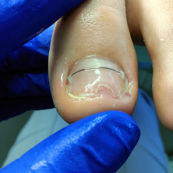 Корекція врослого нігтя
                    Подолог Єлізавета Львів