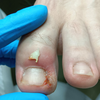 Корекція врослого нігтя
                    Подолог Єлізавета Львів