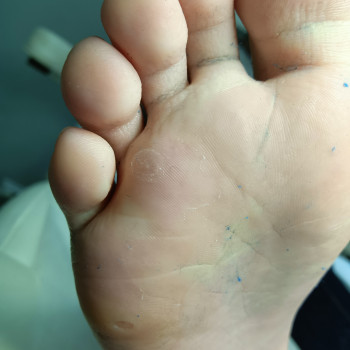 Видалення бородавки
                    Подолог Єлізавета Львов