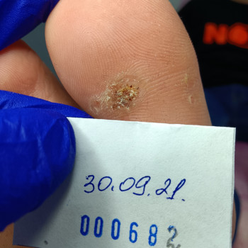 Видалення бородавки
                    Подолог Єлізавета Львов