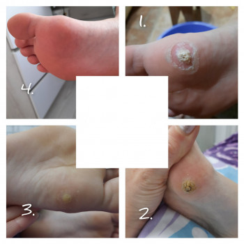 Видалення бородавки
                    Подолог Єлізавета Львов