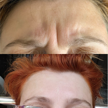 Ботулинотерапия
                    Лікар-косметолог Наталья Київ