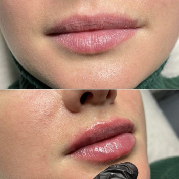 увеличение губ филлером