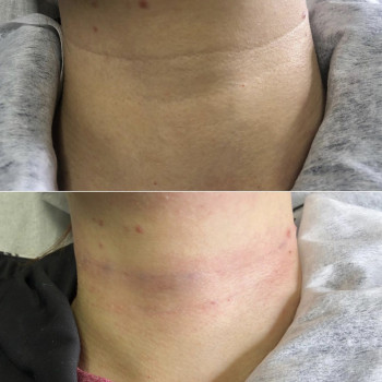 Бланширование колец Венеры на шее
                    Врач-косметолог Наталья Киев