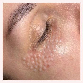 Биоревитализация лица
                    Лікар-косметолог Наталья Київ