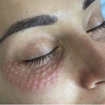 Биоревитализация лица
                    Лікар-косметолог Наталья Київ