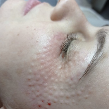 Биоревитализация лица
                    Лікар-косметолог Наталья Київ