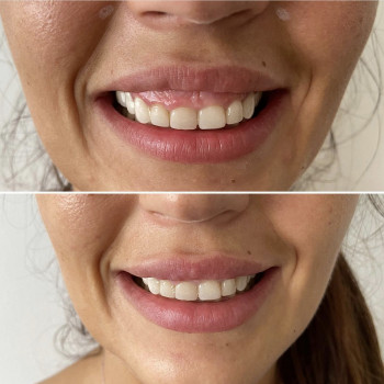 Устранение десневой улыбки
                    Лікар-косметолог Наталья Київ