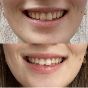 Устранение десневой улыбки
                    Лікар-косметолог Наталья Київ