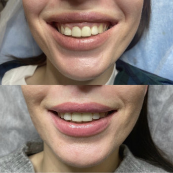 Устранение десневой улыбки
                    Лікар-косметолог Наталья Київ