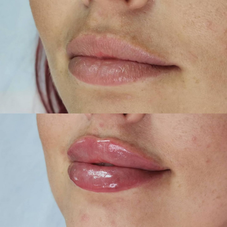 Контурная пластика губ, препарат teosyal kiss, фото - Косметолог-инъекционист Ксения Днепрова