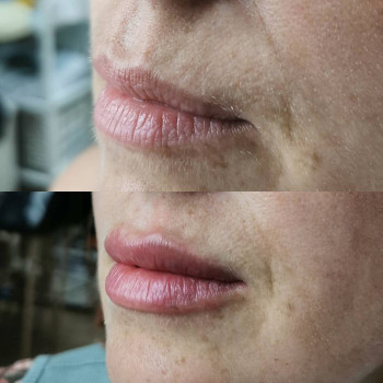 Контурная пластика губ