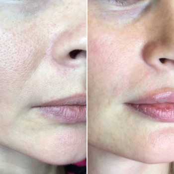 Коррекция носогубки