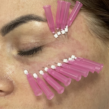 Мононити, укрепление и уплотнение кожи