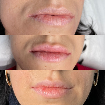 Контурная пластика губ, до, после, и заживите, через 14 дней