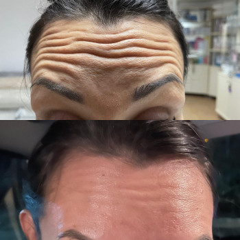 Ботулинотерапия лба