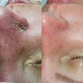 Чистка лица