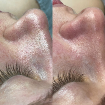 Результат чистки лица