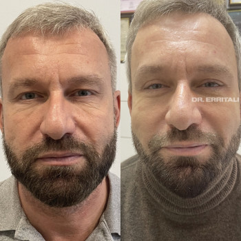 Блефаропластика круговая (верхних и нижних век)
                    Пластический хирург Абдель Харьков