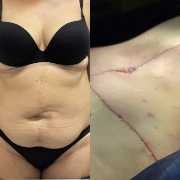 Абдоминопластика (пластика живота)
                    Пластический хирург Абдель Харьков