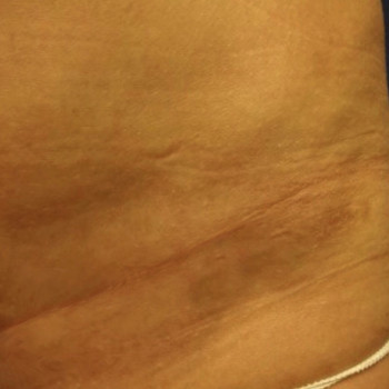 Абдоминопластика (пластика живота)
                    Пластический хирург Абдель Харьков