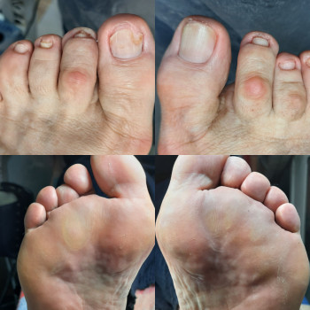 Обработка грибка
Мозолі
    
 
 
 
 
 