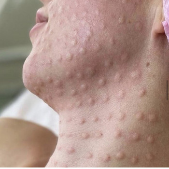 Биоревитализация лица
                    Лікар-косметолог Наталья Київ