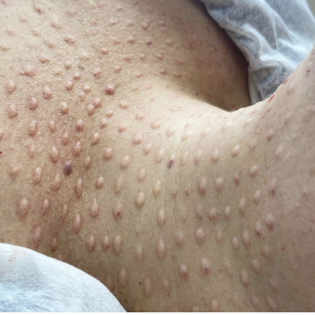 Биоревитализация лица
                    Лікар-косметолог Наталья Київ